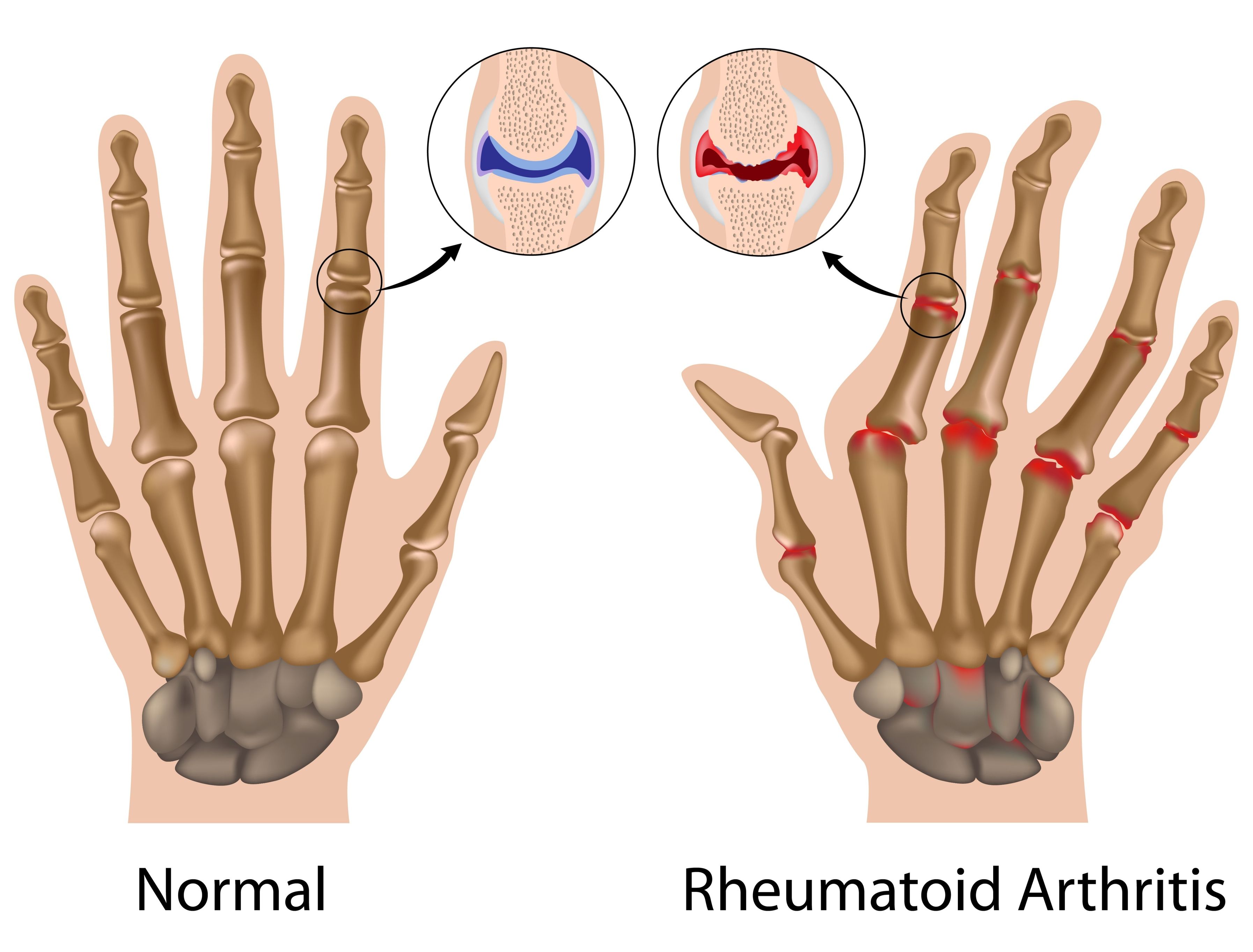 tratamentul homeopatiei reumatismului articular care unguent pentru articulațiile mâinilor este mai bun