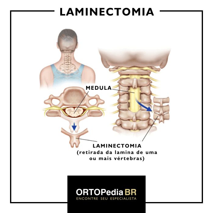 laminectomia
